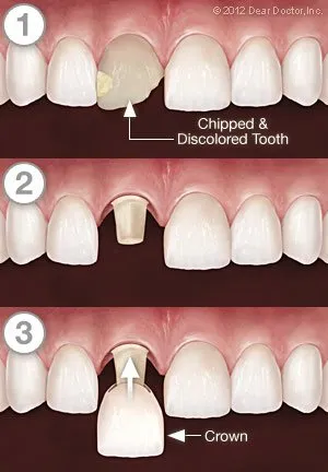 Dental Crowns West Orange, NJ