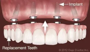 Replace All Teeth Dental Implant West Orange, NJ