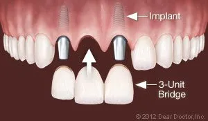 Multiple Teeth Dental Implant West Orange, NJ