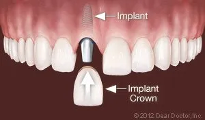 Dental Implant West Orange, NJ