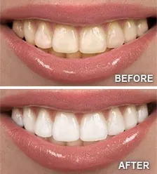 Teeth Whitening Results West Orange, NJ