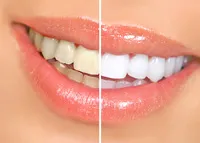 before and after results teeth whitening West Orange, NJ cosmetic dentistry