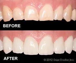 photo of Before and after results Veneers West Orange, NJ