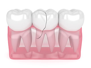 cracked tooth