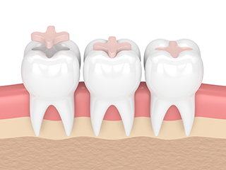 dental inlay