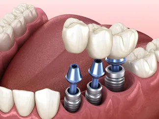 Dental Implants West Orange, NJ