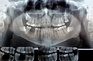 digital x-ray