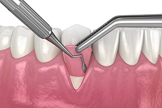 gum graft