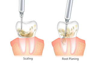 non-surgical perio