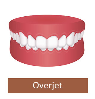 overjet