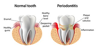 periodontal disease