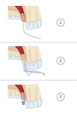 sinus surgery