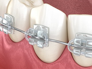 clear braces