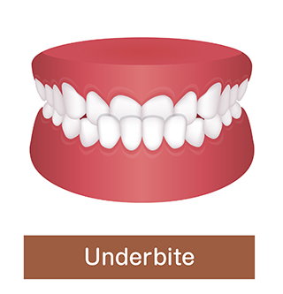 underbite